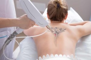 tattoo removal costs explained