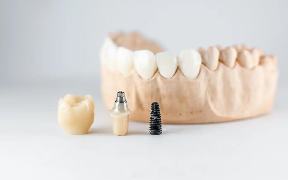 from gap to glow your insider guide to dental implants