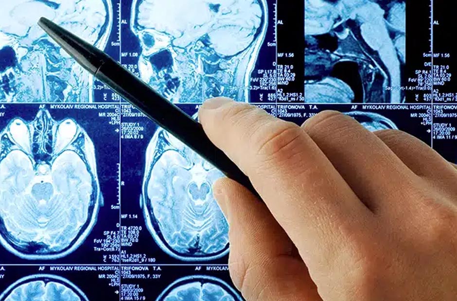 traumatic brain injury