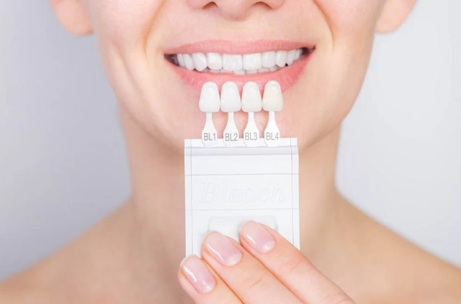 veneers redefining dental harmony through advanced materials