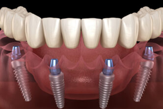 a comprehensive guide to all on 4 dental implants