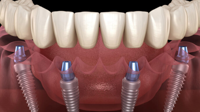 a comprehensive guide to all on 4 dental implants