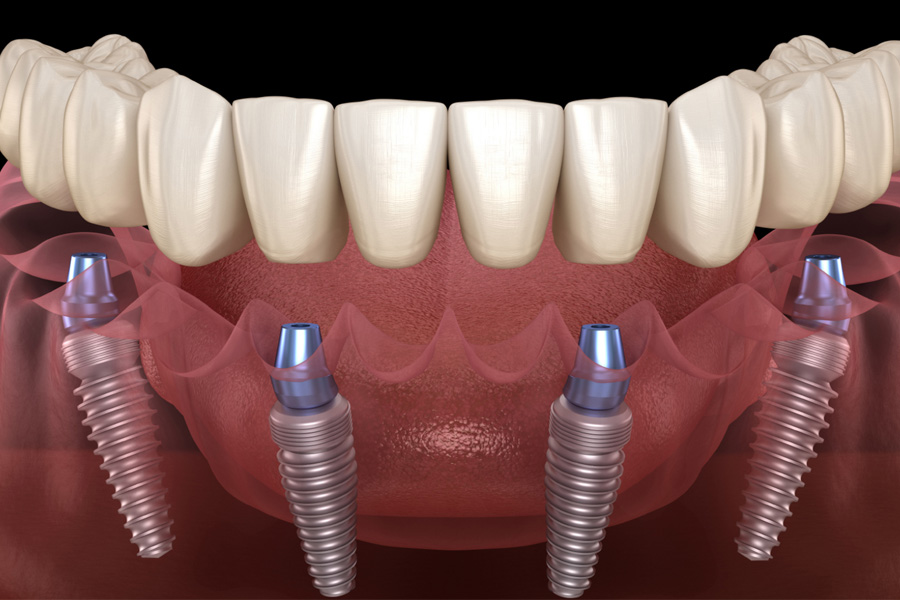 a comprehensive guide to all on 4 dental implants