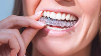 aligners a simple guide for patients