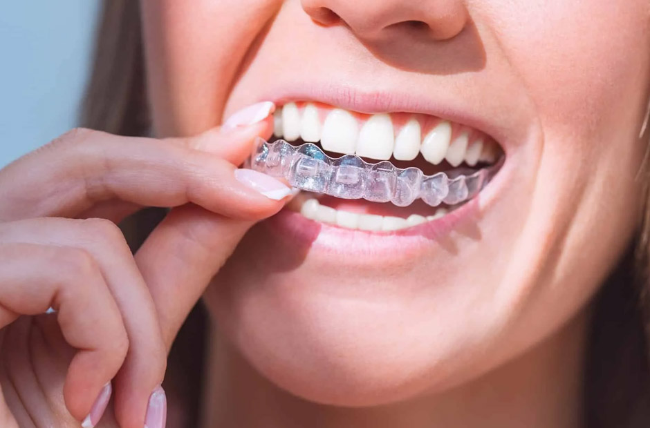 aligners a simple guide for patients